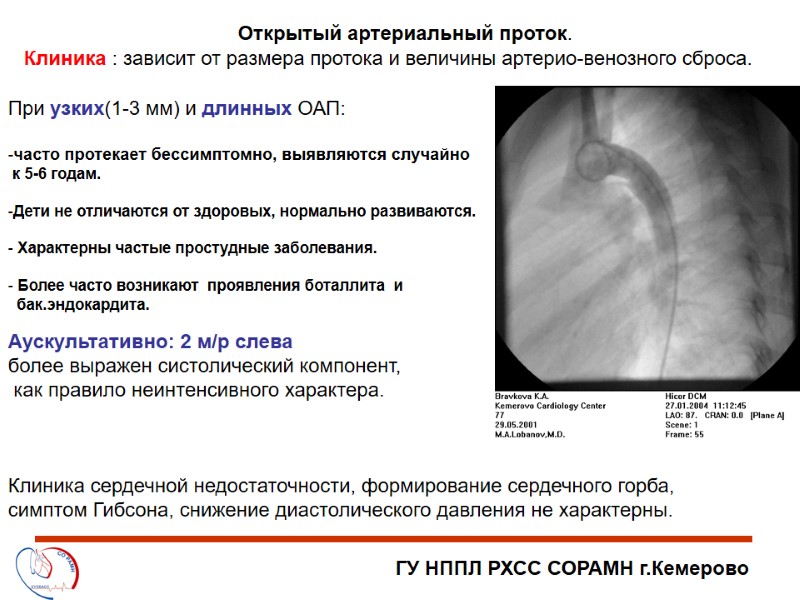 ГУ НППЛ РХСС СОРАМН г.Кемерово Открытый артериальный проток. При узких(1-3 мм) и длинных ОАП: